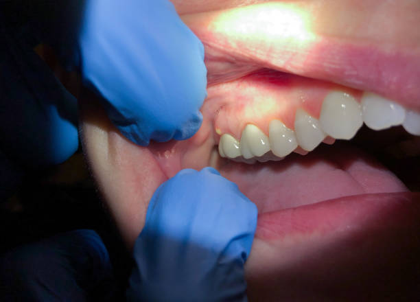 Best Emergency Dentist for Knocked-Out Tooth in Pomona, KS
